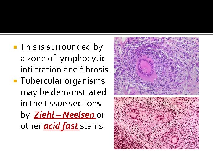 This is surrounded by a zone of lymphocytic infiltration and fibrosis. Tubercular organisms may