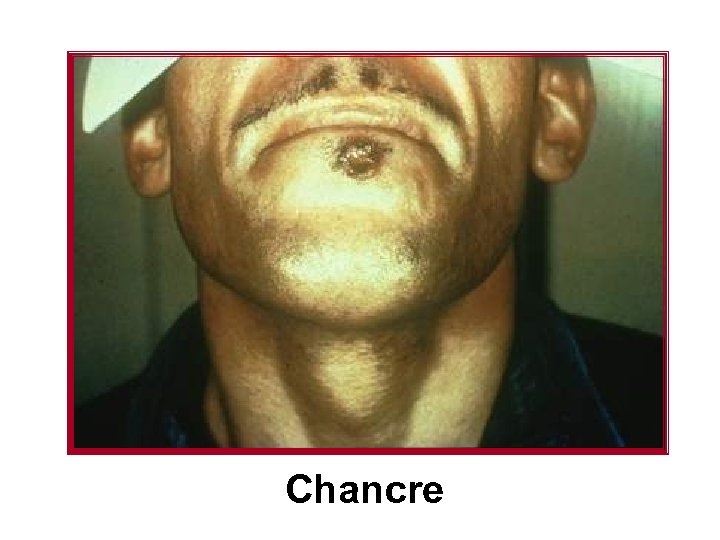 Chancre 