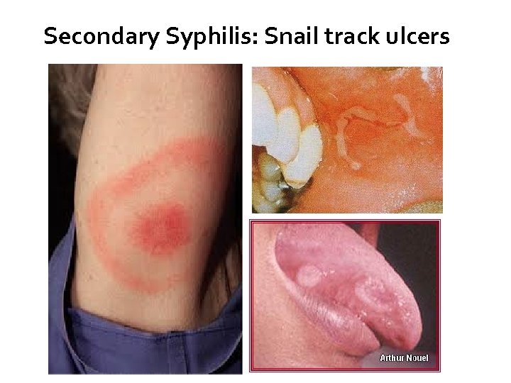 Secondary Syphilis: Snail track ulcers 