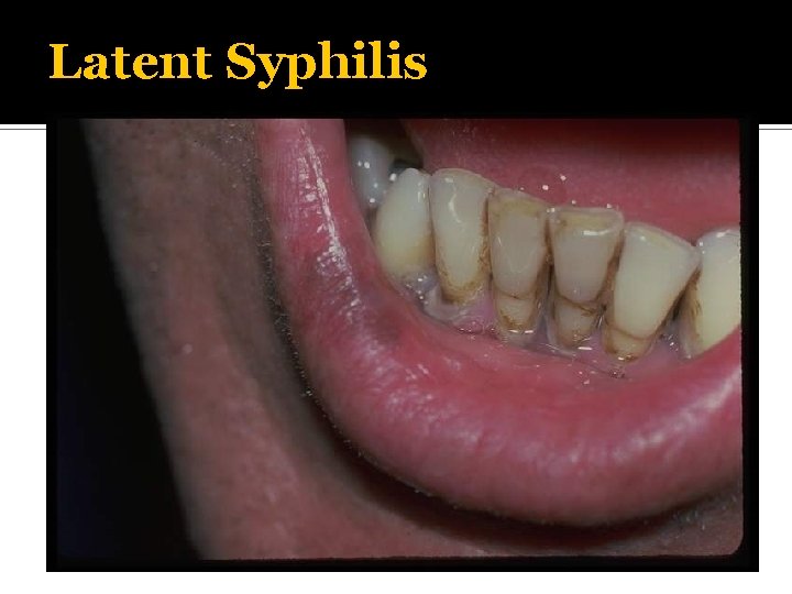 Latent Syphilis 