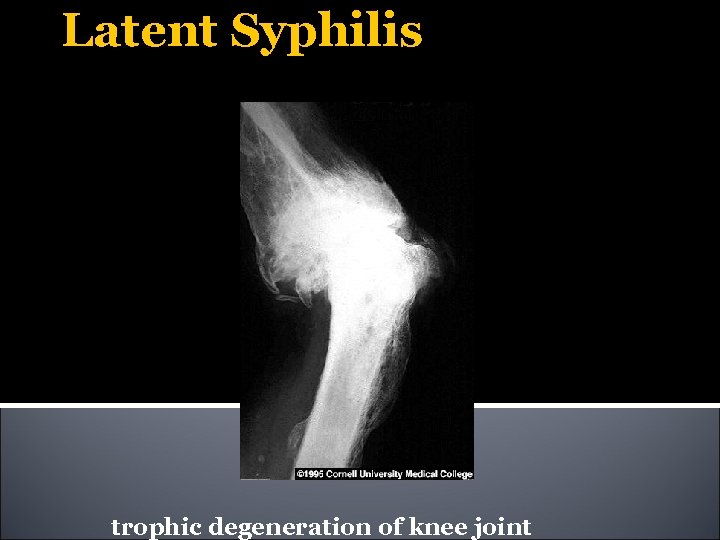 Latent Syphilis trophic degeneration of knee joint 