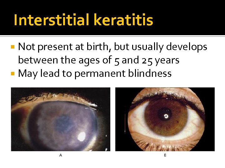 Interstitial keratitis Not present at birth, but usually develops between the ages of 5