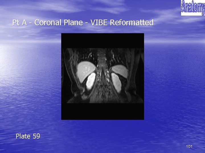 Pt A - Coronal Plane - VIBE Reformatted Plate 59 101 
