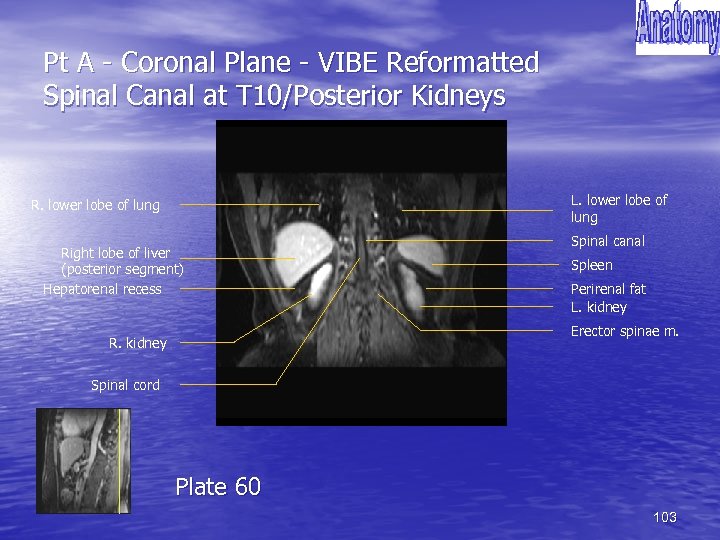 Pt A - Coronal Plane - VIBE Reformatted Spinal Canal at T 10/Posterior Kidneys