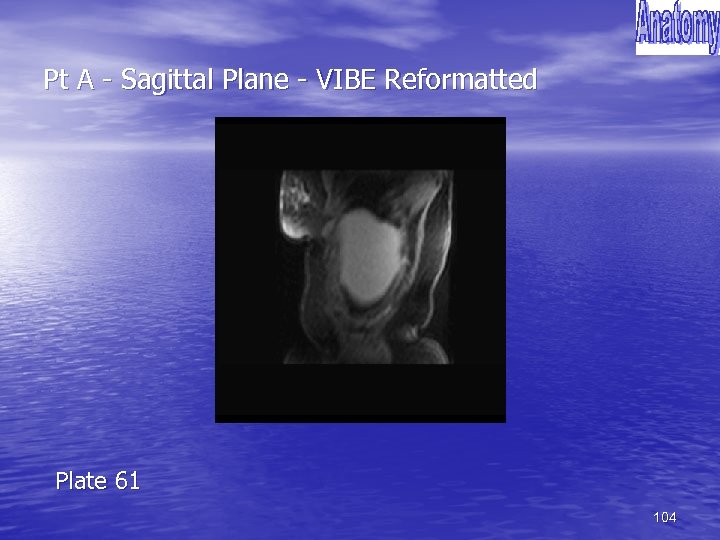 Pt A - Sagittal Plane - VIBE Reformatted Plate 61 104 