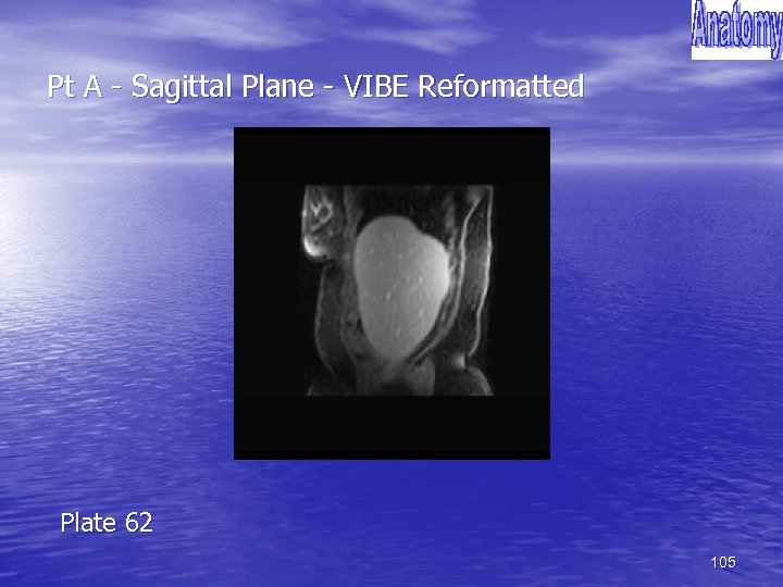 Pt A - Sagittal Plane - VIBE Reformatted Plate 62 105 