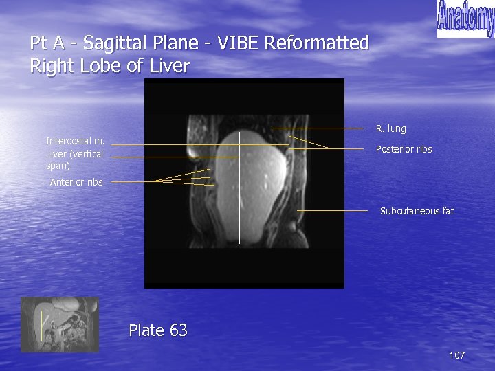 Pt A - Sagittal Plane - VIBE Reformatted Right Lobe of Liver R. lung