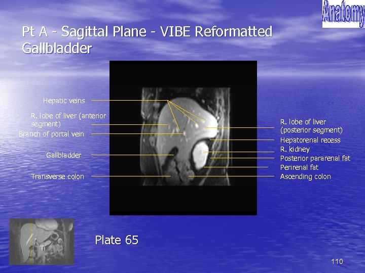 Pt A - Sagittal Plane - VIBE Reformatted Gallbladder Hepatic veins R. lobe of