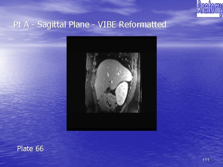 Pt A - Sagittal Plane - VIBE Reformatted Plate 66 111 