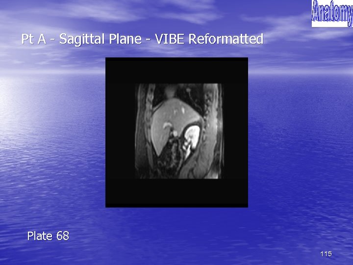Pt A - Sagittal Plane - VIBE Reformatted Plate 68 115 