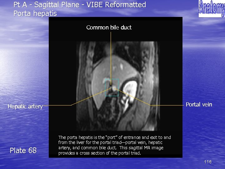 Pt A - Sagittal Plane - VIBE Reformatted Porta hepatis Common bile duct Portal