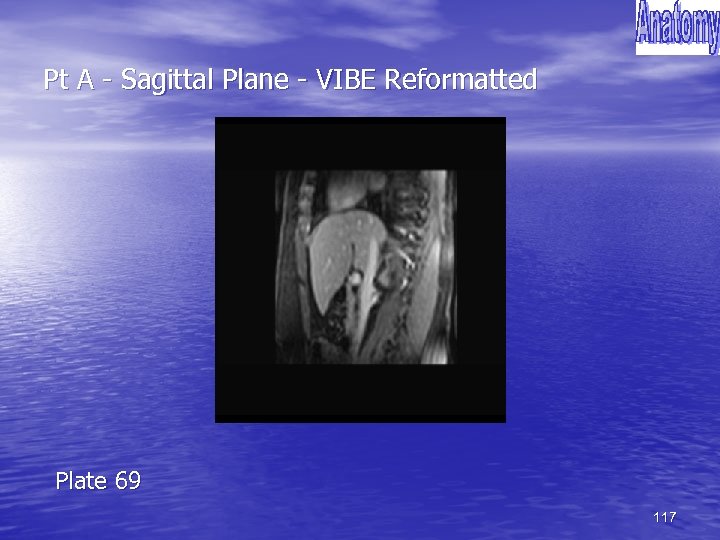 Pt A - Sagittal Plane - VIBE Reformatted Plate 69 117 