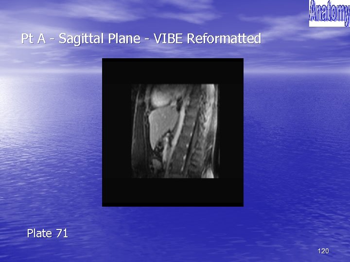 Pt A - Sagittal Plane - VIBE Reformatted Plate 71 120 