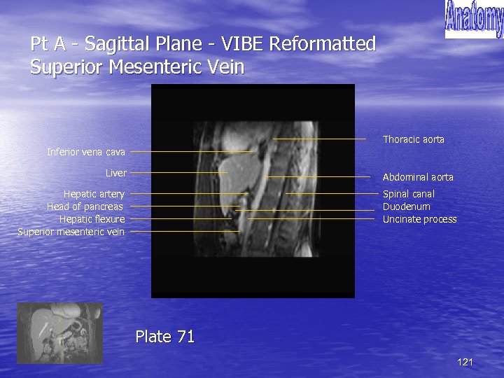 Pt A - Sagittal Plane - VIBE Reformatted Superior Mesenteric Vein Thoracic aorta Inferior