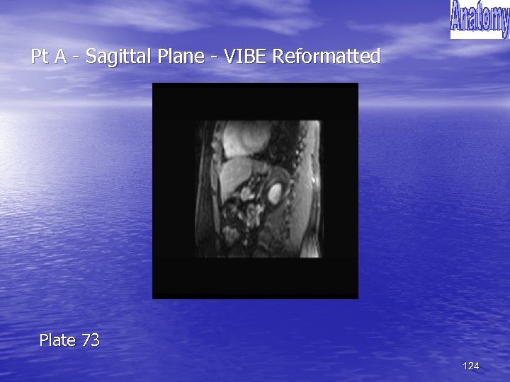 Pt A - Sagittal Plane - VIBE Reformatted Plate 73 124 