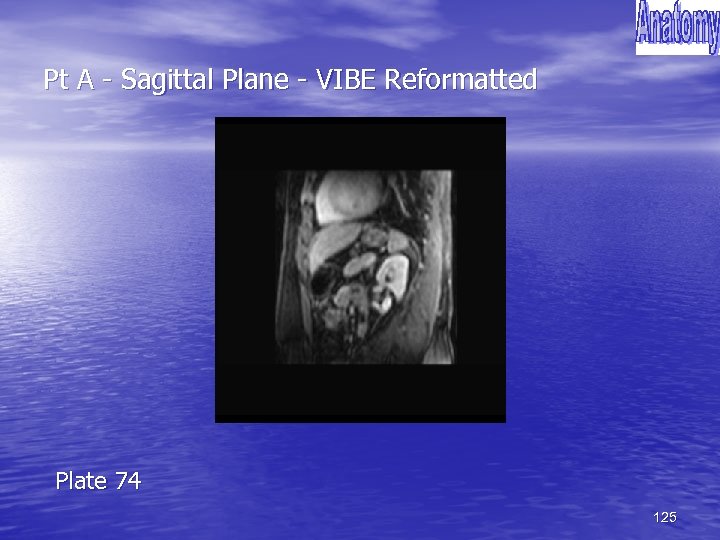 Pt A - Sagittal Plane - VIBE Reformatted Plate 74 125 