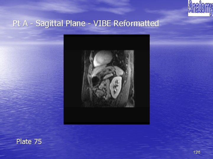 Pt A - Sagittal Plane - VIBE Reformatted Plate 75 126 
