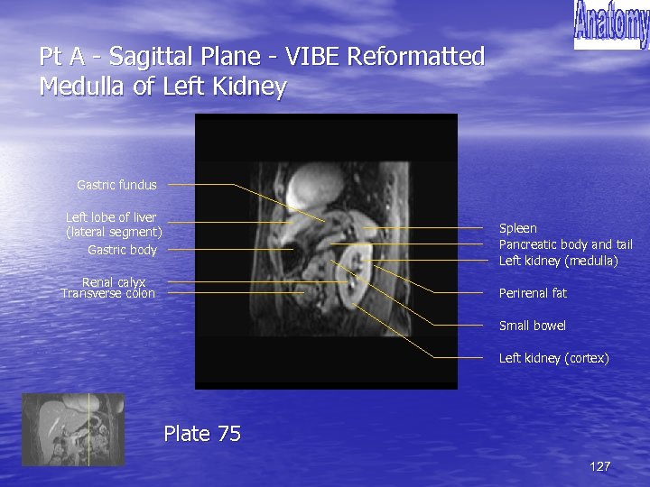 Pt A - Sagittal Plane - VIBE Reformatted Medulla of Left Kidney Gastric fundus