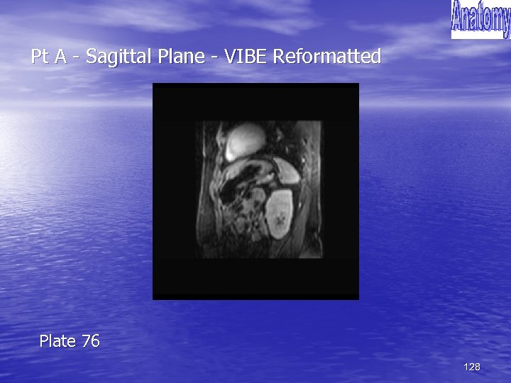 Pt A - Sagittal Plane - VIBE Reformatted Plate 76 128 