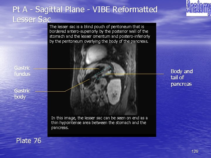 Pt A - Sagittal Plane - VIBE Reformatted Lesser Sac The lesser sac is