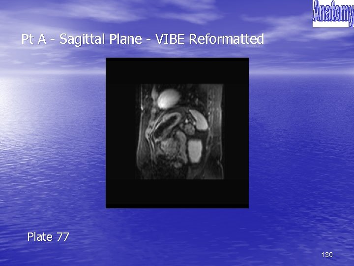 Pt A - Sagittal Plane - VIBE Reformatted Plate 77 130 