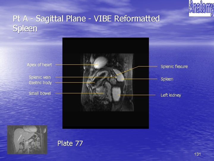 Pt A - Sagittal Plane - VIBE Reformatted Spleen Apex of heart Splenic flexure
