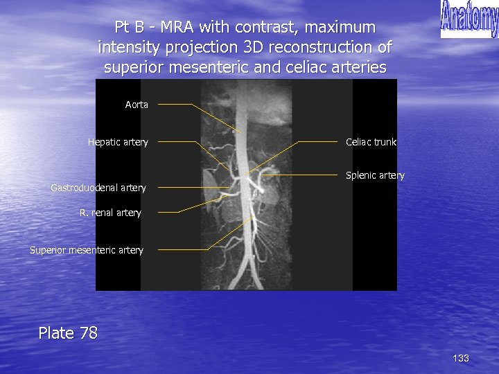Pt B - MRA with contrast, maximum intensity projection 3 D reconstruction of superior