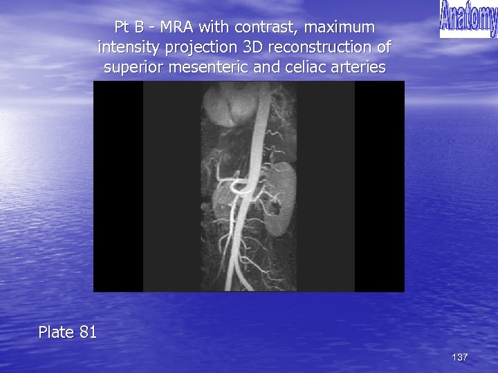 Pt B - MRA with contrast, maximum intensity projection 3 D reconstruction of superior