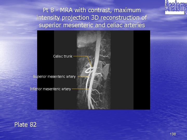 Pt B - MRA with contrast, maximum intensity projection 3 D reconstruction of superior