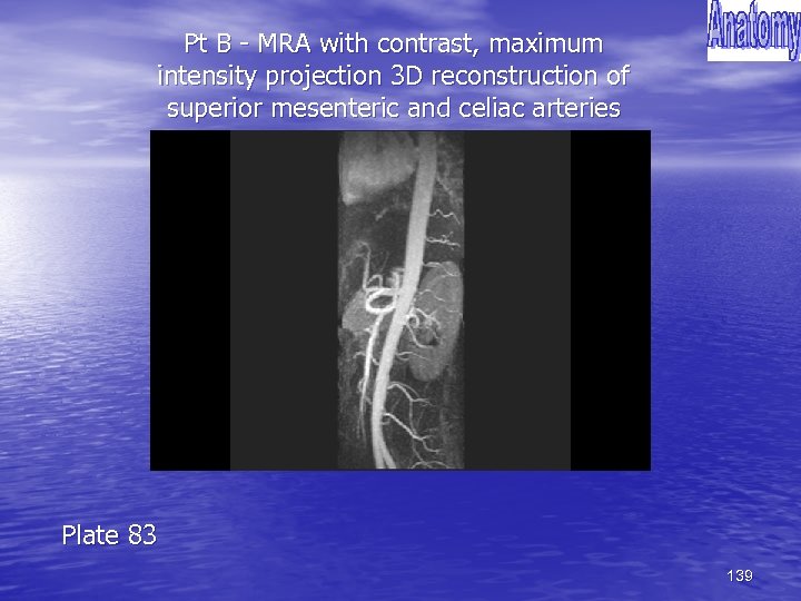 Pt B - MRA with contrast, maximum intensity projection 3 D reconstruction of superior