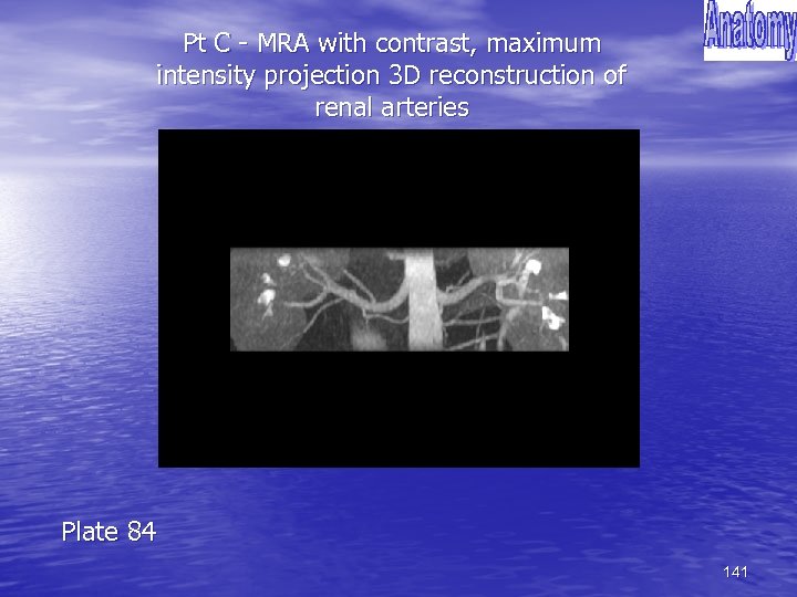Pt C - MRA with contrast, maximum intensity projection 3 D reconstruction of renal