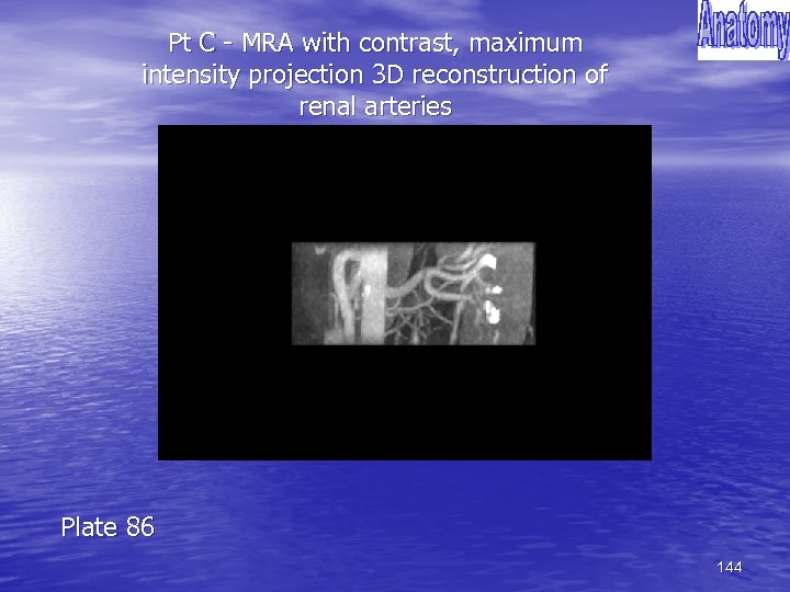 Pt C - MRA with contrast, maximum intensity projection 3 D reconstruction of renal