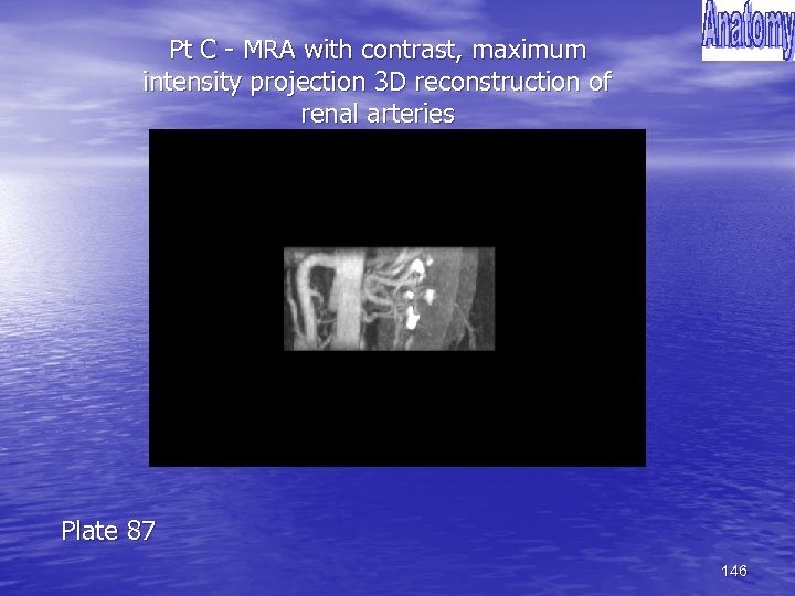 Pt C - MRA with contrast, maximum intensity projection 3 D reconstruction of renal