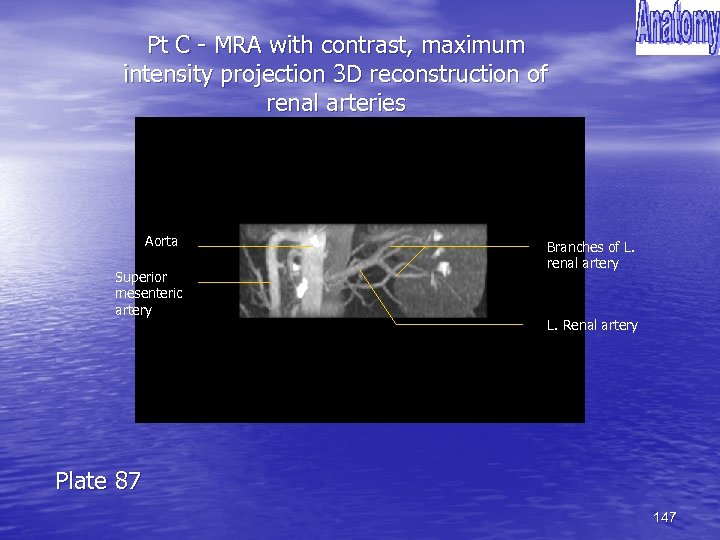 Pt C - MRA with contrast, maximum intensity projection 3 D reconstruction of renal