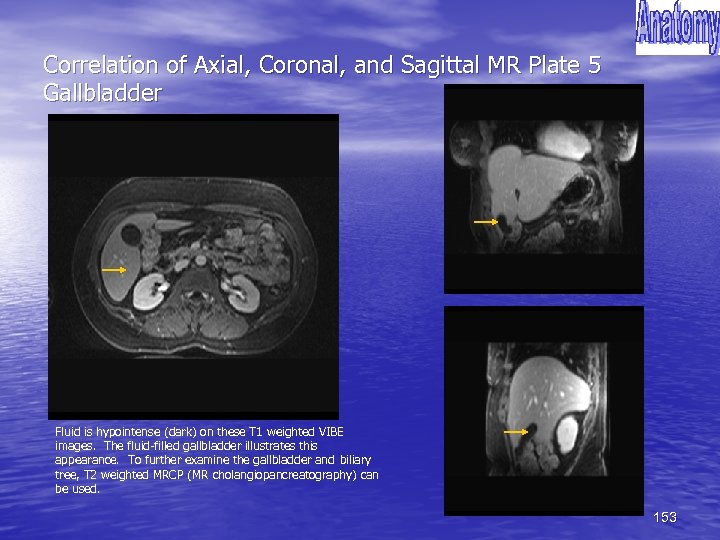 Correlation of Axial, Coronal, and Sagittal MR Plate 5 Gallbladder Fluid is hypointense (dark)