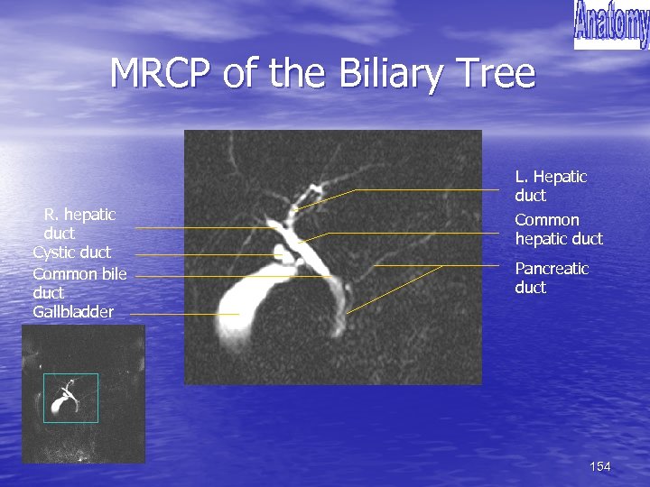 MRCP of the Biliary Tree R. hepatic duct Cystic duct Common bile duct Gallbladder
