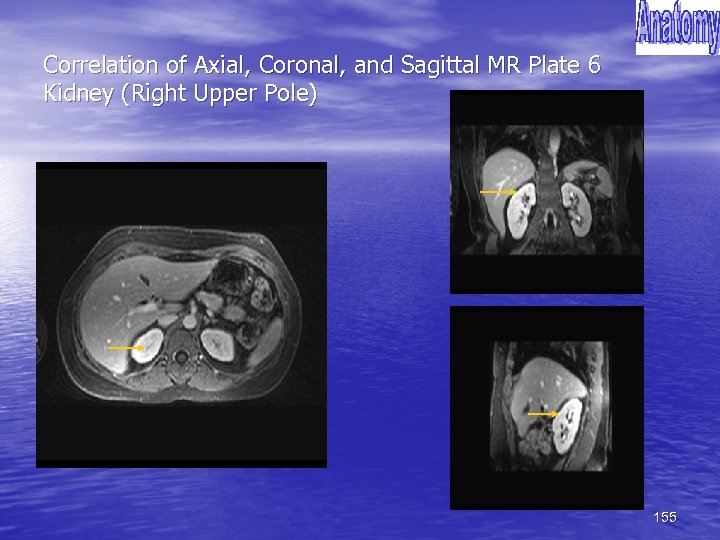 Correlation of Axial, Coronal, and Sagittal MR Plate 6 Kidney (Right Upper Pole) 155