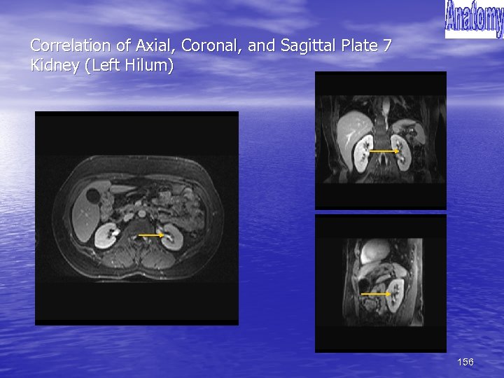 Correlation of Axial, Coronal, and Sagittal Plate 7 Kidney (Left Hilum) 156 