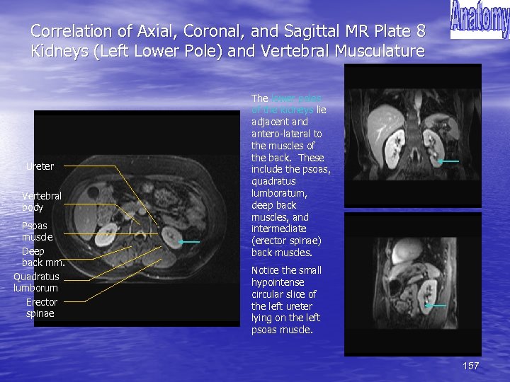 Correlation of Axial, Coronal, and Sagittal MR Plate 8 Kidneys (Left Lower Pole) and
