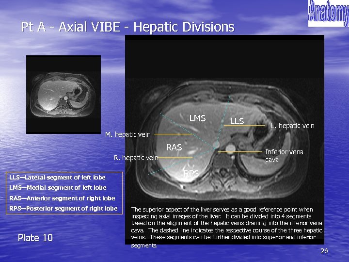 Pt A - Axial VIBE - Hepatic Divisions LMS LLS L. hepatic vein M.