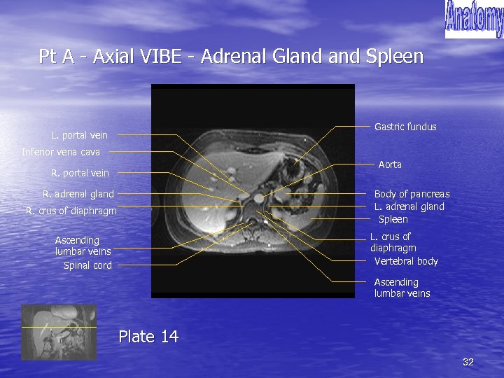 Pt A - Axial VIBE - Adrenal Gland Spleen Gastric fundus L. portal vein