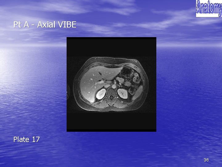 Pt A - Axial VIBE Plate 17 36 