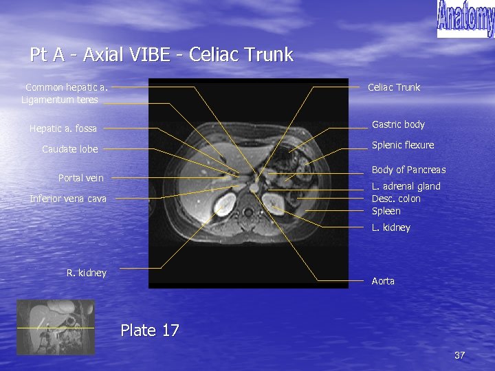 Pt A - Axial VIBE - Celiac Trunk Common hepatic a. Ligamentum teres Celiac