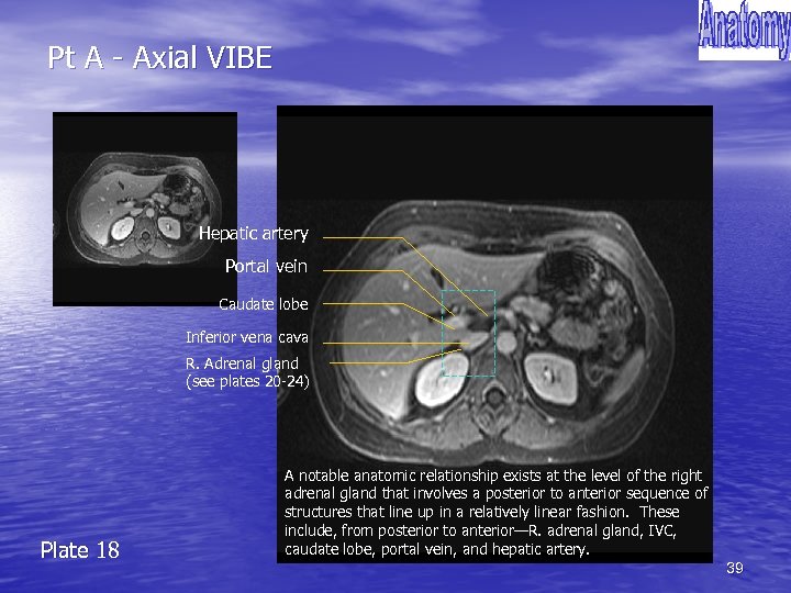 Pt A - Axial VIBE Hepatic artery Portal vein Caudate lobe Inferior vena cava