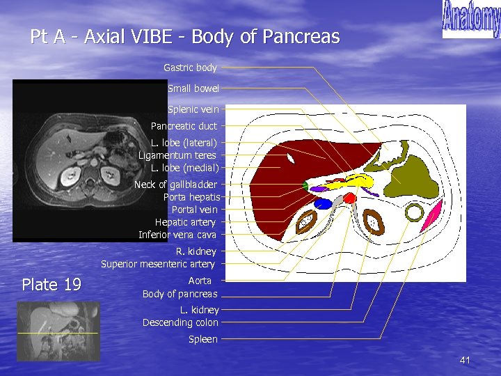 Pt A - Axial VIBE - Body of Pancreas Gastric body Small bowel Splenic