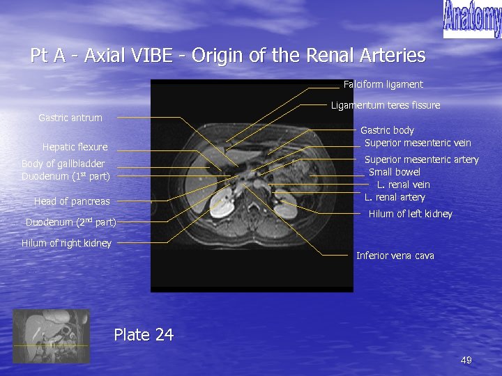 Pt A - Axial VIBE - Origin of the Renal Arteries Falciform ligament Ligamentum