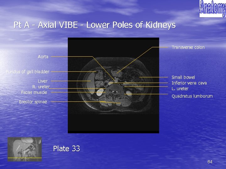 Pt A - Axial VIBE - Lower Poles of Kidneys Transverse colon Aorta Fundus