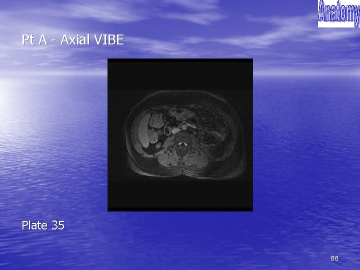 Pt A - Axial VIBE Plate 35 66 