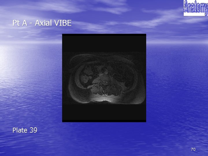 Pt A - Axial VIBE Plate 39 70 