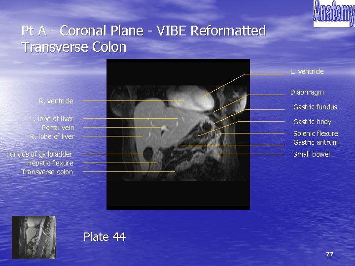 Pt A - Coronal Plane - VIBE Reformatted Transverse Colon L. ventricle Diaphragm R.